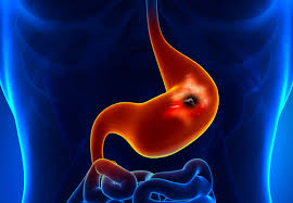 You should see your doctor if you have unexplained weight loss or you have symptoms that are unusual for you or that won't go away. Researchers Uncover Concerning Rise In Gastric Cancer Despite Careful Monitoring In Fap Patients Consult Qd