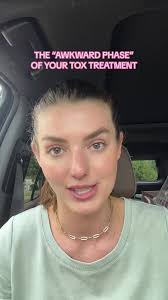 Let’s talk about the #awkwardphase of your #botox treatment! #neurotoxin  #neuromodulators #myinjectorleeza #aestheticinjector #botoxinjection  #aestheticnurseinjector