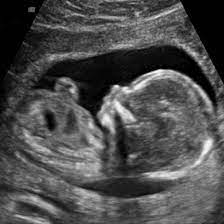 Women greater than 14 weeks will have an ultrasound through the abdomen. Ultrasound Pregnancy Test Price Pregnancy Test