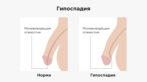 Нарушения формирования пола у детей