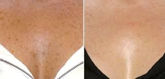 Nevus)‏ هو مصطلح طبي لعلامة خِلقية مرئية على الجلد أو الغشاء المخاطي. Ø§Ù„Ø¨Ù‚Ø¹ Ø§Ù„Ù…ØµØ·Ø¨ØºØ© Ø¹Ù„Ù‰ Ø§Ù„ØµØ¯Ø± Ø§Ù„ØµÙˆØ±Ø© Ø§Ù„Ø£Ø³Ø¨Ø§Ø¨ ÙˆØ§Ù„Ø¹Ù„Ø§Ø¬ ÙƒÙŠÙÙŠØ© Ø¥Ø²Ø§Ù„Ø© Ø§Ù„Ø¨Ù‚Ø¹ ØªØµØ¨Øº Ø¹Ù„Ù‰ Ø§Ù„ØµØ¯Ø± ÙÙŠ Ø§Ù„Ù†Ø³Ø§Ø¡