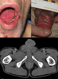 Image result for Neurosyphilis