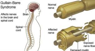 Sindromul guillain barre este o afectiune autoimuna care poate sa apara la orice varsta. Syndromo Gullain Barre Kentro Apo8erapeias Apokatastashs Attica Kentro Apo8erapeias Apokatastashs Attica