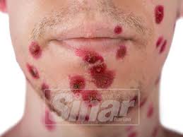 It requires lot of patience to reduce their appearance. Vaksin Kurangkan Risiko Terkena Cacar Air