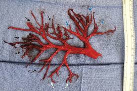 8 natural remedies for blood clots. Check Out This Massive Intact Blood Clot Someone Coughed Up