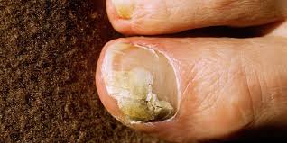 If untreated, it can expand and become a darker yellow/green colour that comes to discolour the hi, i'm gabrielle. 6 Natural Ways To Defeat Toenail Fungus Runner S World