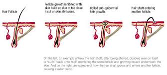 Are ingrown hairs the same as razor bumps or pseudofolliculitis? Faqs Nicolsons Electrolysis Effective Permanent Hair Removal Method