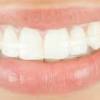 Then, after those three months, the retainer may only need to put their retainer in at nighttime. 1