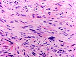 Image result for Leiomyosarcoma