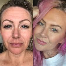 Hey friend. Derm is somewhat correct for permanent elimination. Laser  treatment can very much minimize