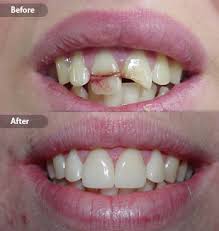 Root canal treatment on a live. Smile Gallery Before And After Dental Photos Smile Makeovers Kissimmee Fl