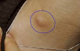 However, sebaceous cysts are often referred to as small lumps that feel caught under the skin. Lump Under Armpit Painful Hard Male Female Sore Small Red Swollen Tender Lump In Armpit Hurts In 2020 Lump Under Armpit Armpit Lump Armpits
