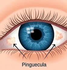 Example Of A Pinguecula On The White Part Of The Eye Parts Of The Eye Eyes Eye Care