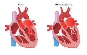 Influence of surgery on the natural history of rheumatic mitral and aortic valve disease. Mitral Stenosis Concise Medical Knowledge