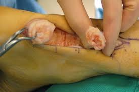 The achilles tendon often ruptures while people are playing sport or exercising, especially when changing direction quickly. Achilles Tendonitis Vasta Performance Training And Physical Therapy
