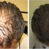 Hair growth begins inside the hair follicle. 1