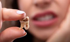 Image result for Tooth Extraction