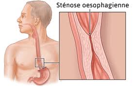 Le bicarbonate de soude a d'innombrables vertus : Stenose De L Oesophage Definition Causes Symptomes Diagnostic Traitements Reflux Gastro Oesophagien Reflux Gastrique
