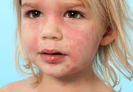 5 Rashes Your Child May Bring Home From Preschool Cleveland Clinic