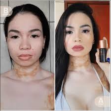 Vitiligo Concealer Starter Kit