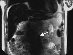 But the magnet is very powerful. Optimizing Abdominal Mr Imaging Approaches To Common Problems Radiographics
