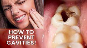 What Is Dental Decay? How To Prevent Cavities! - Youtube