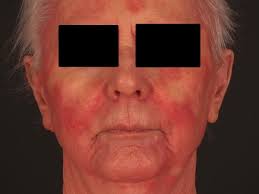 Rhinophym ist eine seltene von einer großen, rot, holprig nase gekennzeichnet hauterkrankung. Sezary Syndrom Altmeyers Enzyklopadie Fachbereich Dermatologie