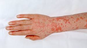 Strep Throat And Scarlet Fever What S The Connection Everyday Health