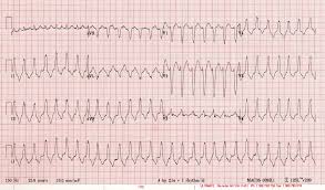 Vt Versus Svt With Aberrancy Medical Textbooks Nursing Notes Emergency Medicine