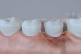 Advanced Gum Disease Ocala Fl Dental Implants Of Ocala