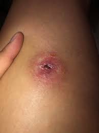 What does one look like? Brown Recluse Bite Texas 2 Weeks After First Sign Brownreclusebites
