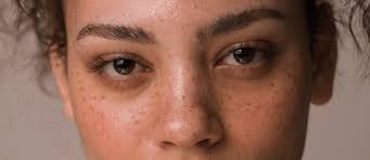 Image result for Freckled skin