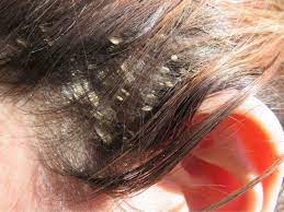 In most cases, dandruff doesn't directly cause hair loss. Dandruff Vs Dry Scalp Causes Treatment And Prevention