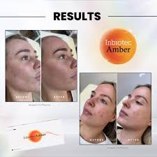 THE LOWDOWN ON SKIN BUILDERS ✨ We have a brand new product at Wilson  Aesthetics 💉 Skin Builders are a revolutionary new aesthetic treatment  providing all the benefits of a skin booster