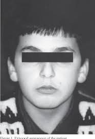 PDF] An unusual case of talon cusp