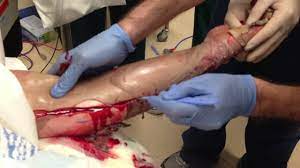 This will allow reperfusion of the limb distally or chest or abdominal expansion consider the need for escharotomy prior to transfer. Build Your Own Escharotomy Man Greater Sydney Area Hems