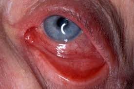Image result for Eye Pain without Redness