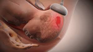 Image result for Forceps Assisted Delivery