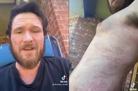 Lubbock Man Makes Plea to Community for Help With Skin Condition