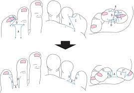 The best way to remove hemstitching is with your seam ripper, but scissors will work if you're careful not to clip the fabric. Schema Of The Surgical Technique Of The Bell Bottom Flap Modified Download Scientific Diagram