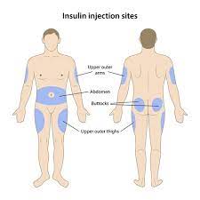 Located on the anterior lateral aspect of the thigh, place the heel of the hand on the greater trochanter of the femur with finger pointing. Why Is My Blood Glucose High Diabetes My Way Greater Manchester Wigan Tameside Nhs