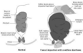Image result for Fecal Incontinence
