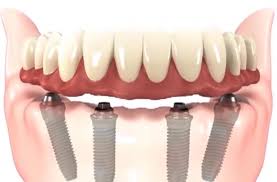 0.35 ounce (pack of 1) 3.9 out of 5 stars. Dental Implant Cost In Nyc Implant Dentist 212 Smiling