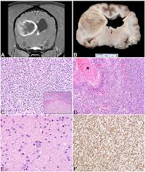 Tumors in the brainstem can be rapidly fatal if, for example, they affect the control of breathing, but typically the first signs of brainstem disease are a loss of balance (vestibular signs), and weakness on one side of the body. Frontiers Canine Primary Intracranial Cancer A Clinicopathologic And Comparative Review Of Glioma Meningioma And Choroid Plexus Tumors Oncology