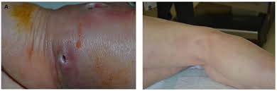 Image result for erythema nodosum