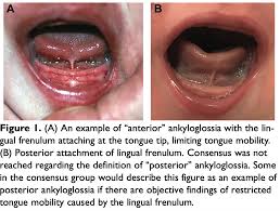 Image result for Ankyloglossia
