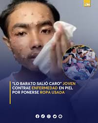 😱 ¿En Honduras? Un joven contrajo una extraña enfermedad en la piel luego  de usar ropa de bulto, su historia rápidamente se viralizó en Honduras.  😳🤯 Conoce los detalles 👉🏻:  https://oncenoticias.hn/videos/joven-contrae-enfermedad-molusco-contagioso  ...