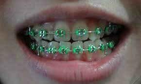 The top countries of suppliers are pakistan, china, and pakistan, from which the percentage of pink and. Teal Braces Pictures Braces Colors Braces Bands Cute Braces