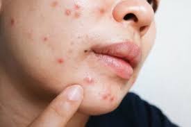 Clinical improvement in nodular acne patients occurs in association with a reduction in sebum secretion. Benefits And Side Effects Of Isotretinoin For Acne Step To Health