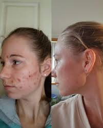 Keloid Scars: Causes & Treatment